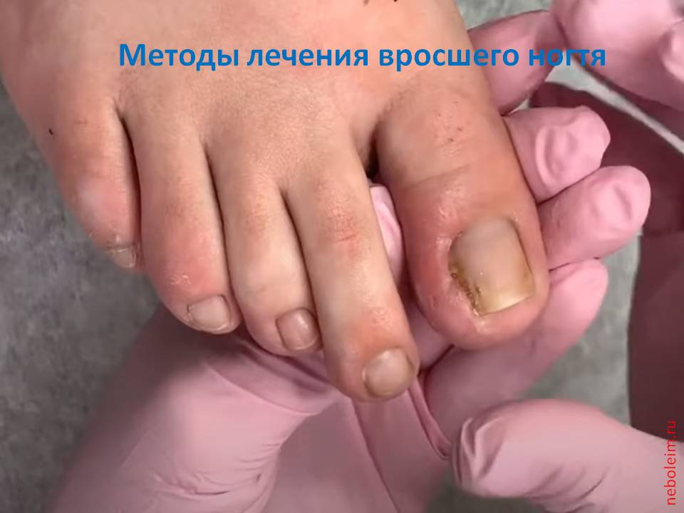 Методы лечения вросшего ногтя