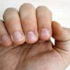 Как избавиться от белых пятен на ногтях