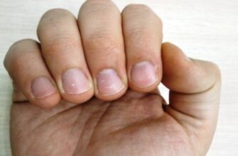 Как избавиться от белых пятен на ногтях